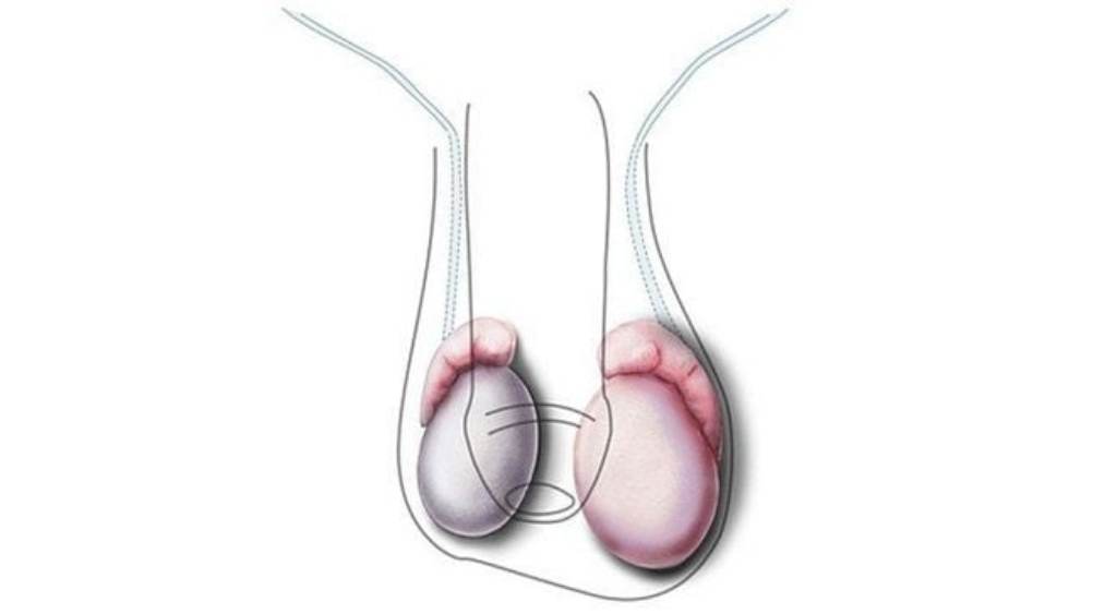 suy giảm testosterone ở người trẻ